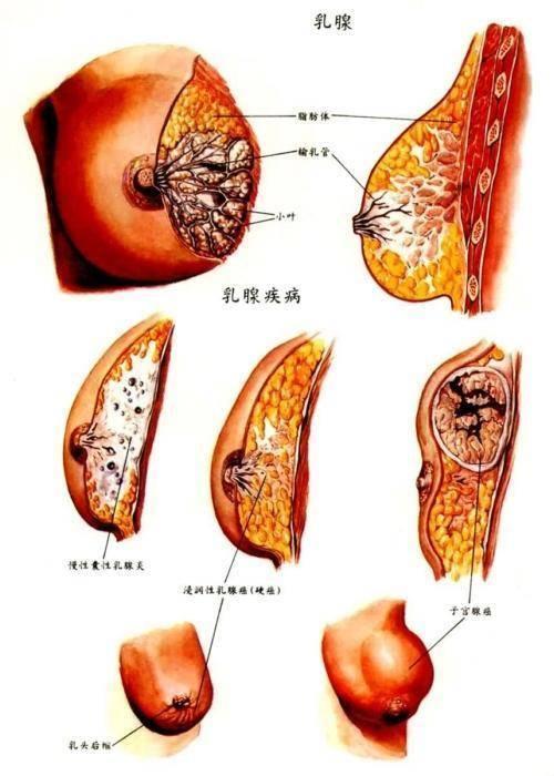 乳腺癌取代肺癌成全球第一大癌,济南乳腺病医院院长直播详解乳腺